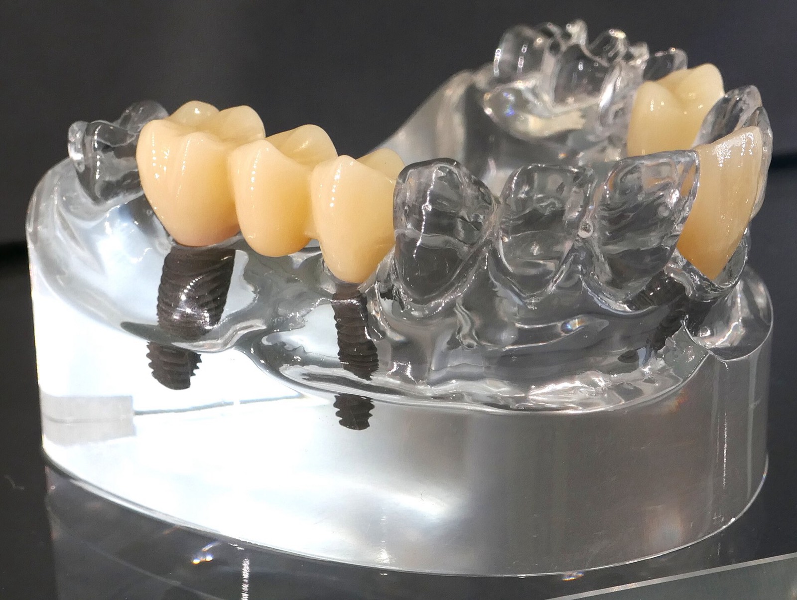 A model of dental implants and crowns